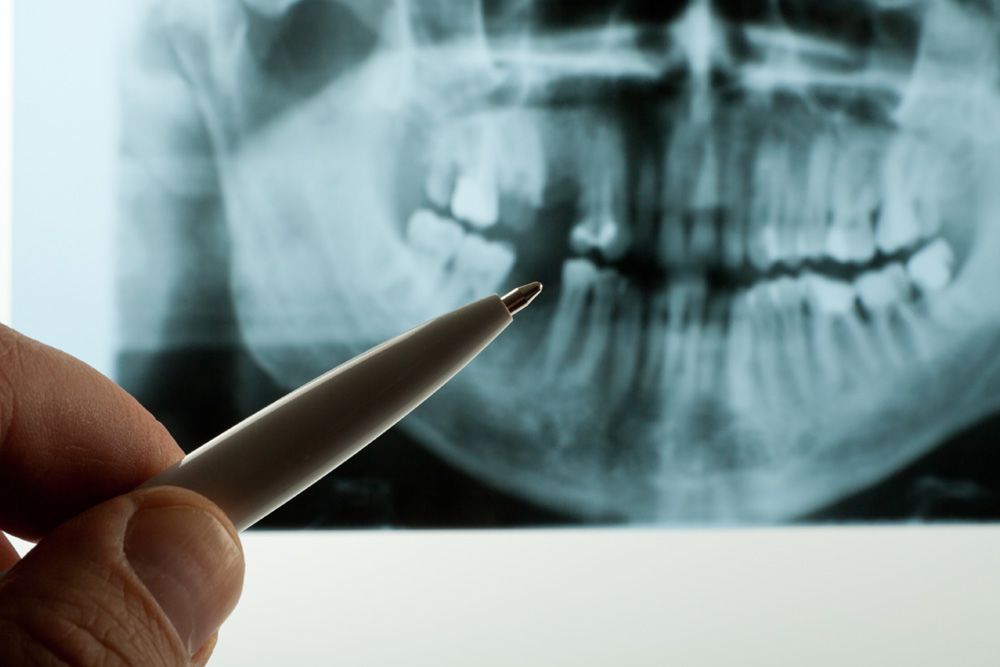 Pen pointing to dental x-ray showing missing tooth