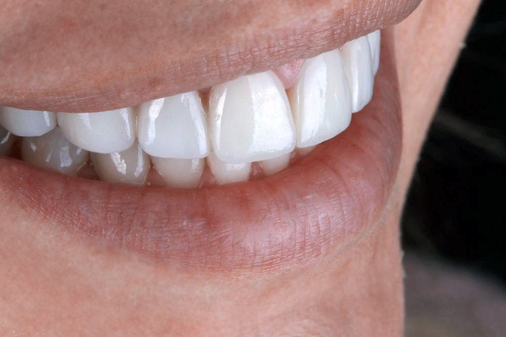 Closeup of a smiling person's teeth