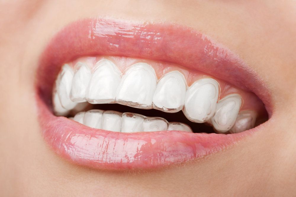 Invisalign tray over teeth