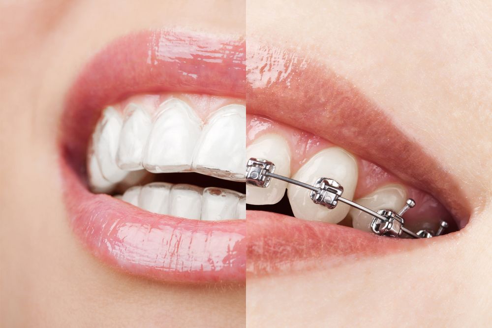 Comparison of Invisalign and traditional braces