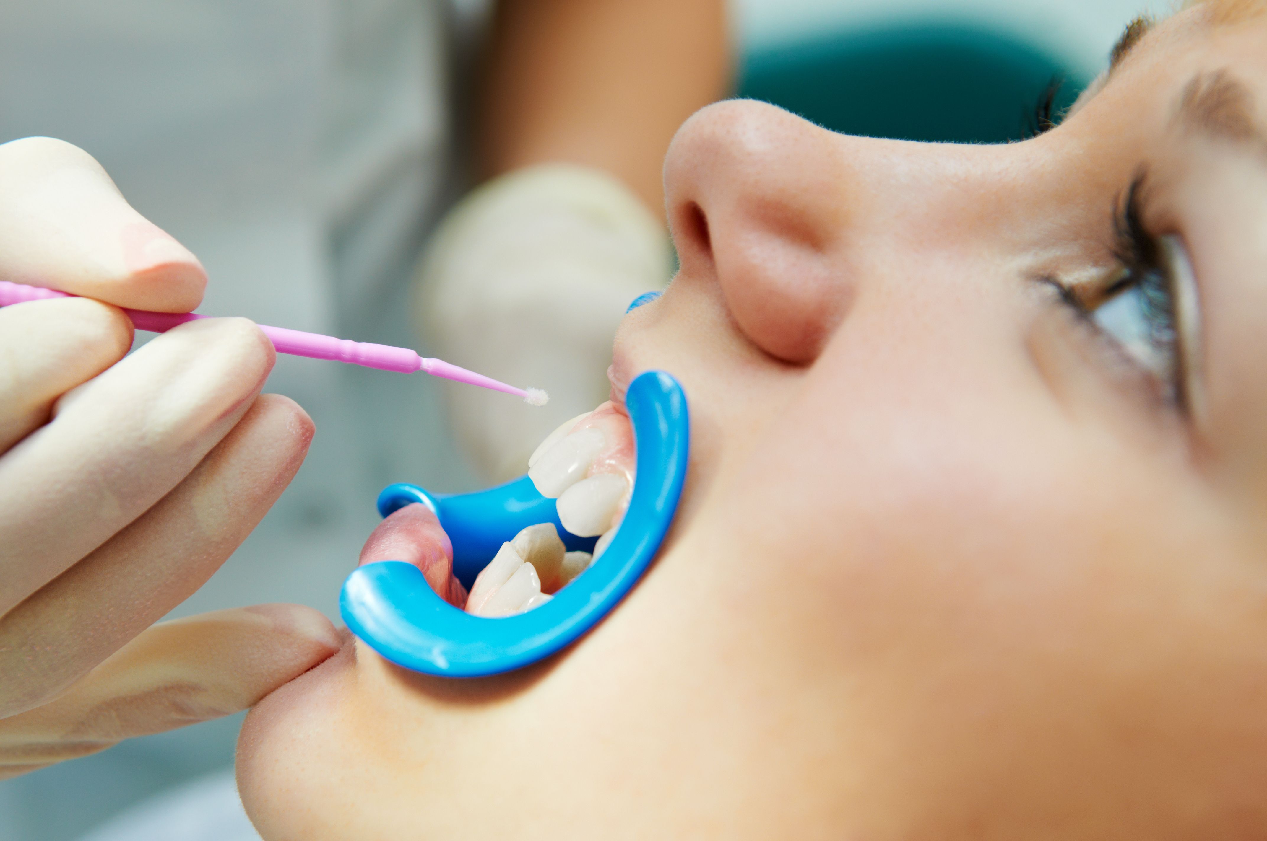 Child receiving dental sealants at the office